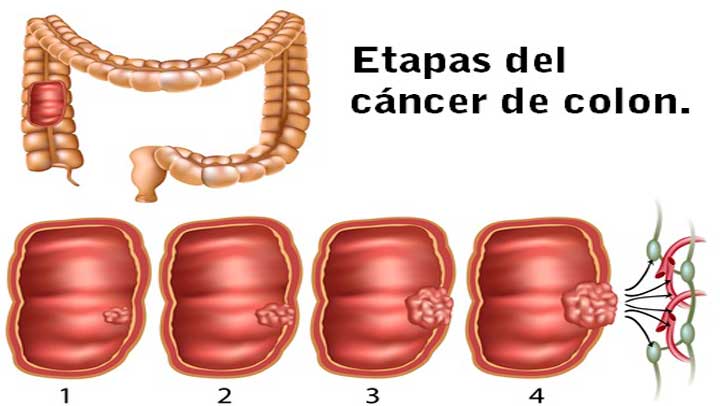 cancer de colon