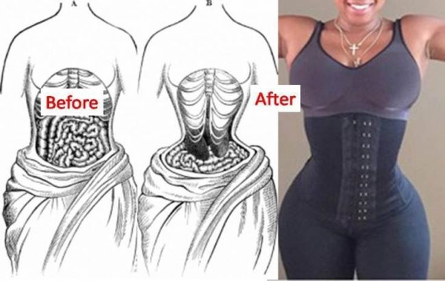 corset peligros