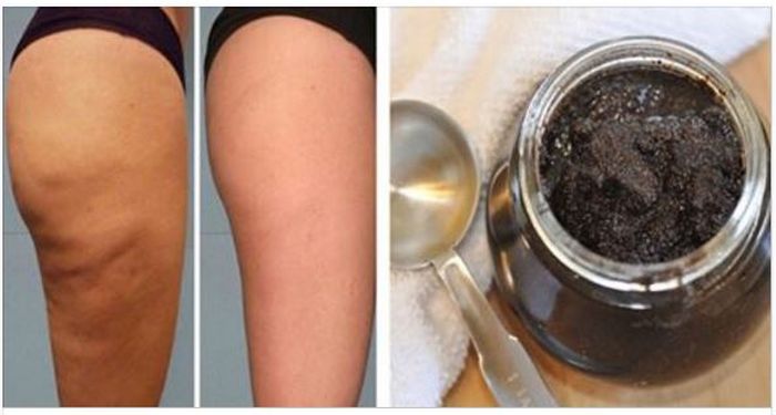 ELIMINAR CELULITIS CON BORRA DE CAFE