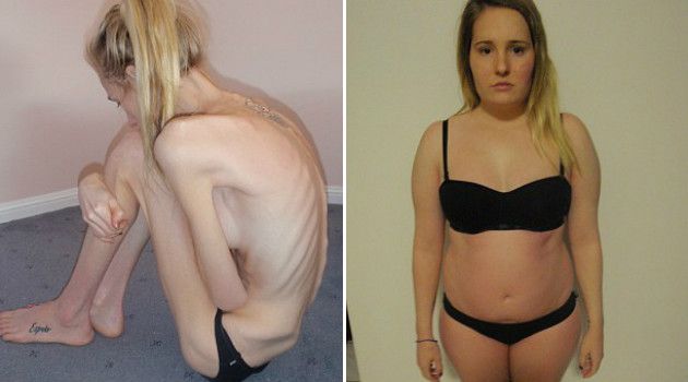anorexia-corpo-antes-depois-australia-2