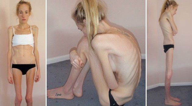 anorexia-corpo-antes-depois-australiana-capa