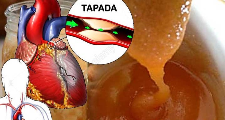 arterias tapadas