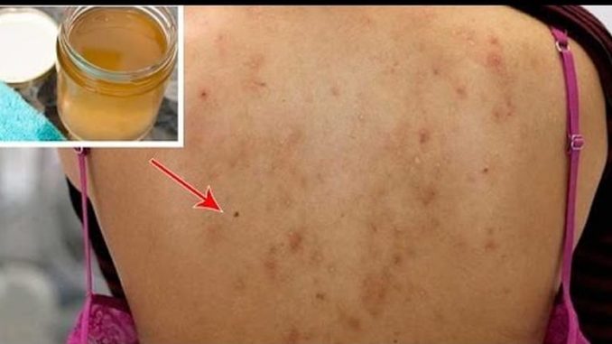 acne espalda